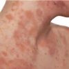 Dry Skin and Eczema